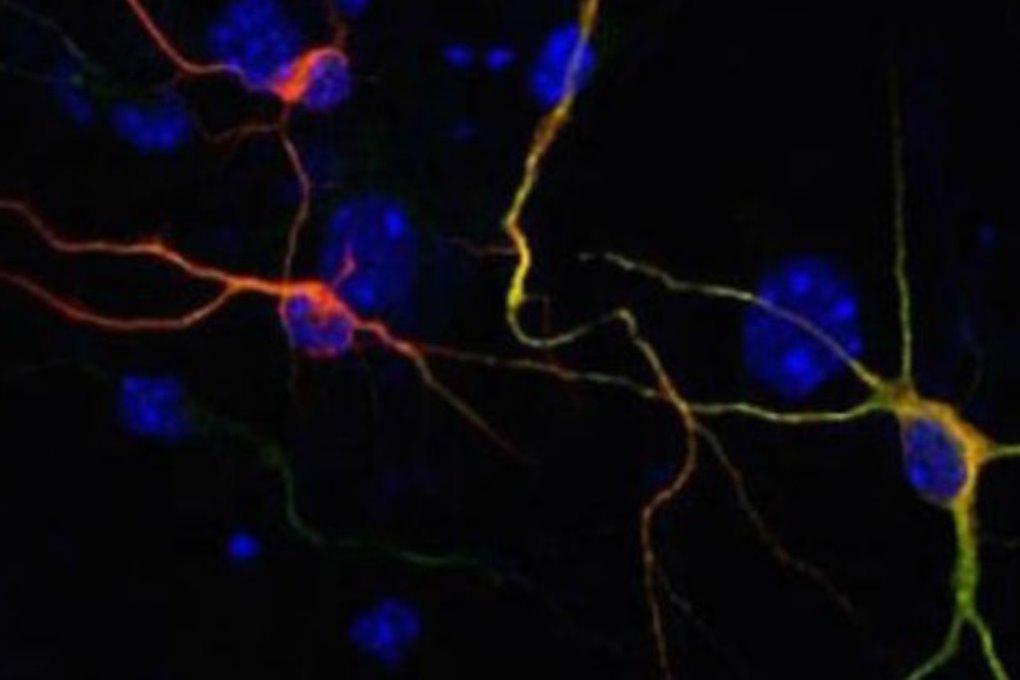 Учёные превратили клетки кожи больных Альцгеймером в новые клетки мозга