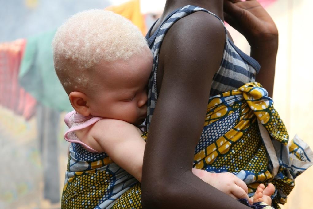 В Африке ради колдовских ритуалов убивают альбиносов