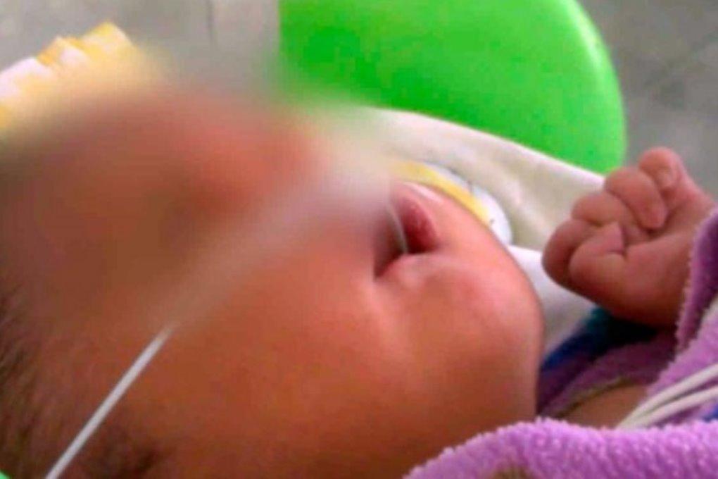 В Перу родился ребенок с двумя носами