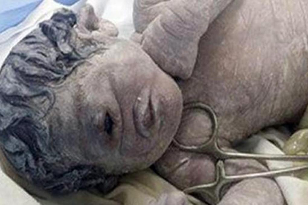 В Египте родился ребенок с одним глазом и без носа